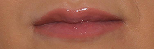 Filler in the Lips