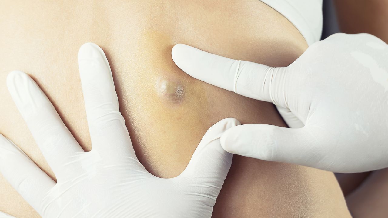 Why Excision is the Preferred Treatment for Pilar, Epidermoid, and Sebaceous Cysts 1 Doctor Diagnosis of the Sebaceous on Woman's Back