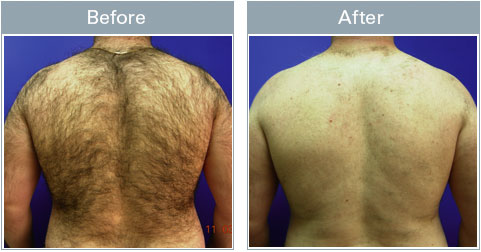 Laser hair removal shop boston