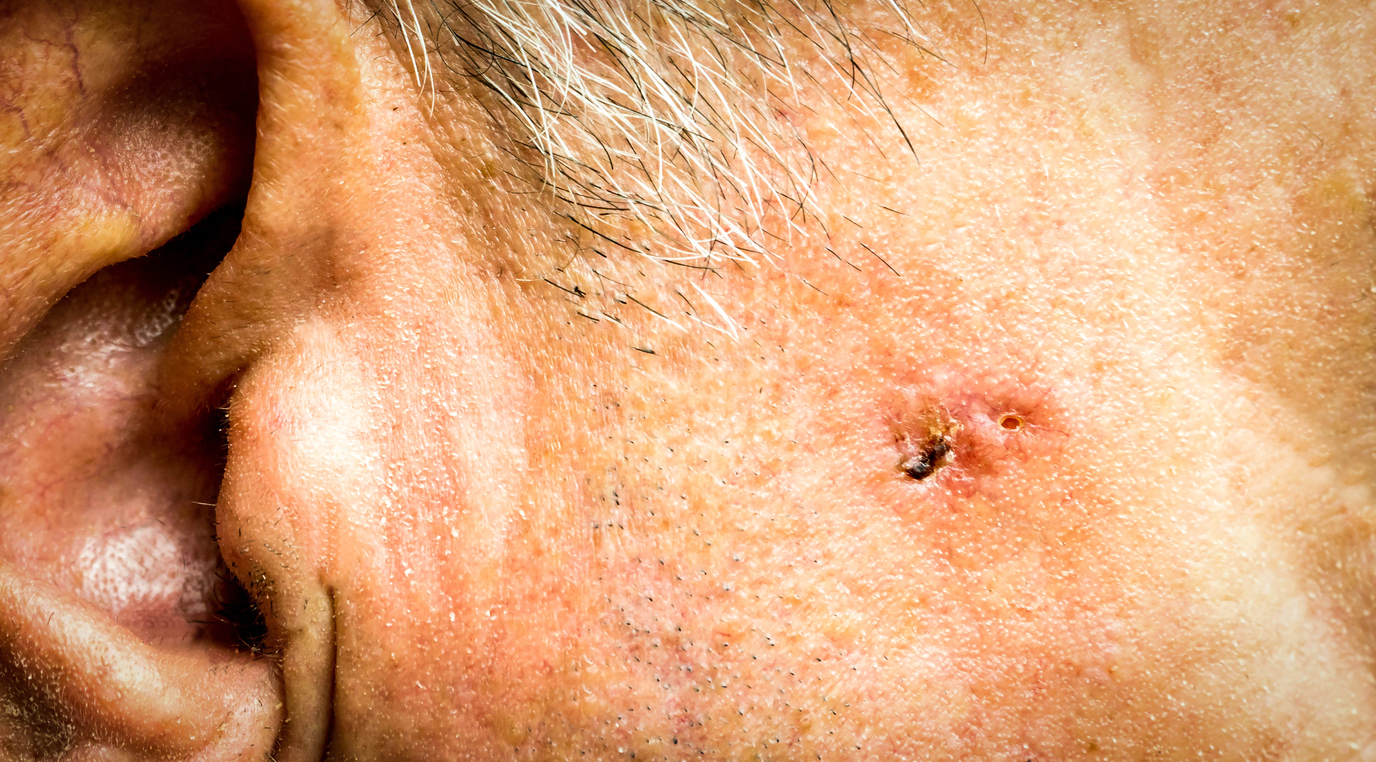 Basal Cell Carcinoma