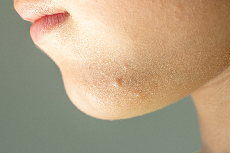 Molluscum contagiosum store